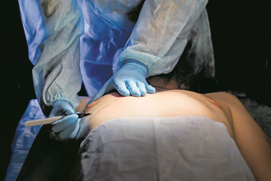 cirurgia, tratamento, x