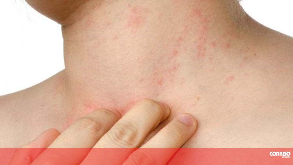 Urticaria por frío: La alergia que puede ser mortal en verano – Sociedade