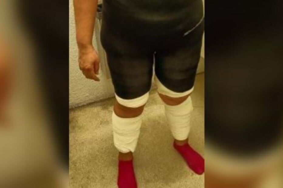 Mulher distribuiu droga  por quatro placas coladas ao corpo com fita adesiva.