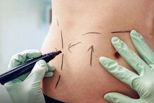 cirurgia, intervenção estética 