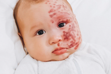 “Monstro”: Mãe é criticada por remover a laser marca de nascença de bebé na Austrália 
