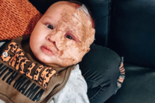 “Monstro”: Mãe é criticada por remover a laser marca de nascença de bebé na Austrália 