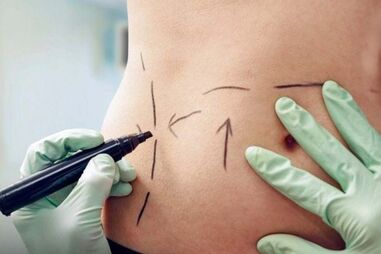 cirurgia, intervenção estética 