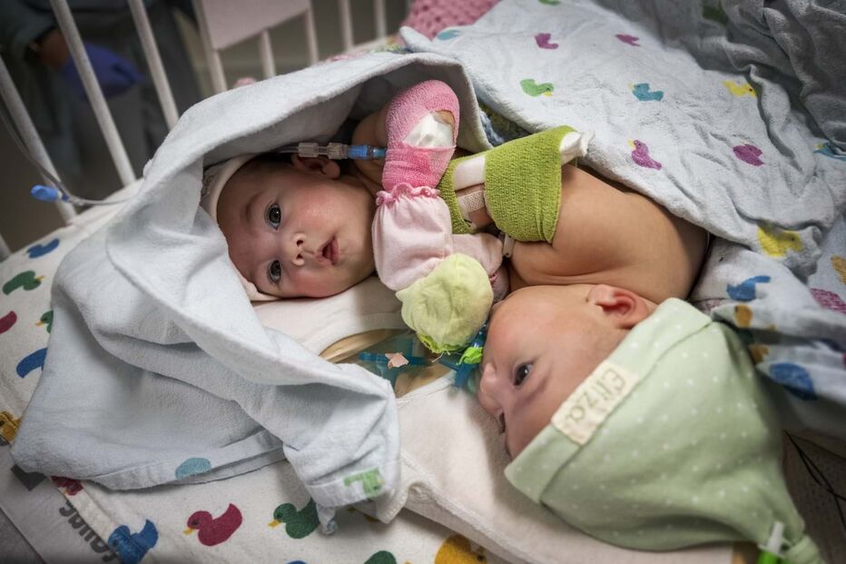 Bebés siamesas unidas pelo abdómen regressam a casa 
