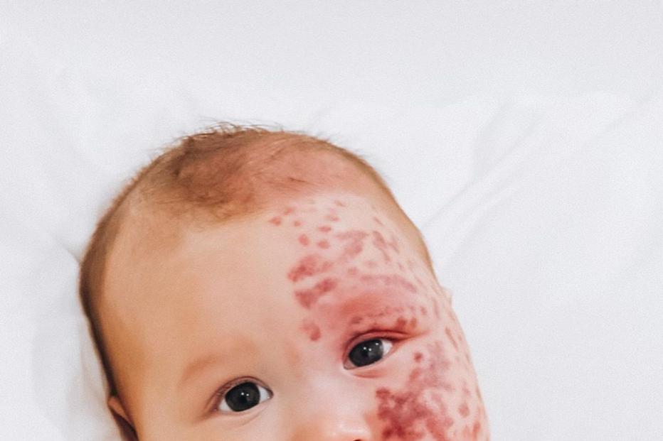 “Monstro”: Mãe é criticada por remover a laser marca de nascença de bebé na Austrália 