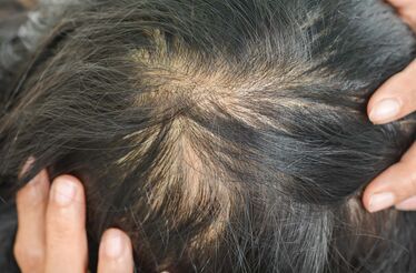 Anda a cair-lhe muito cabelo? Perceba se é "normal" ou doença