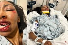 Carrie Bernans desfigurada após atropelamento