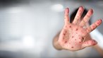 Dois novos casos de sarampo confirmados na última semana em Portugal