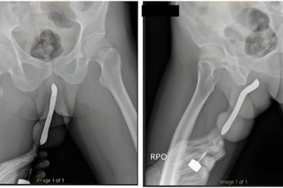 Homem fratura pénis com escova dos dentes