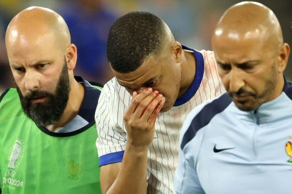 Mbappé partiu o nariz