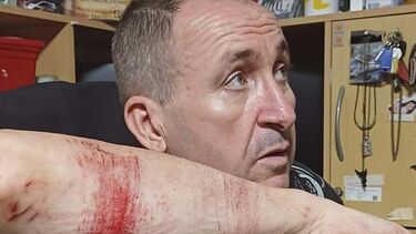 Pedro Santos ficou com arranhões nos braços e no peito	