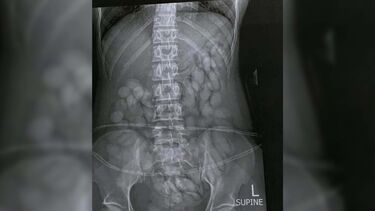 Raio-x mostra estômago de ‘mula de droga’ cheio de cápsulas de cocaína