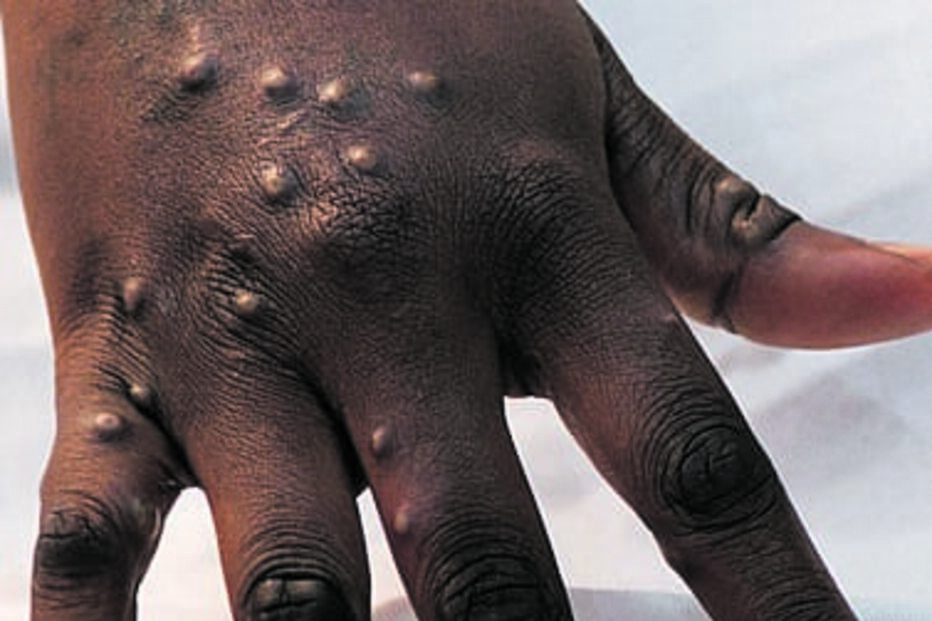 Mpox é epidemia mundial 