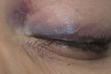 Jéssica Silva com lesão no olho