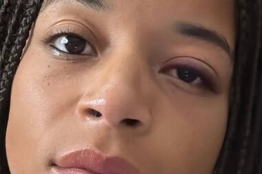 Jéssica Silva com lesão no olho