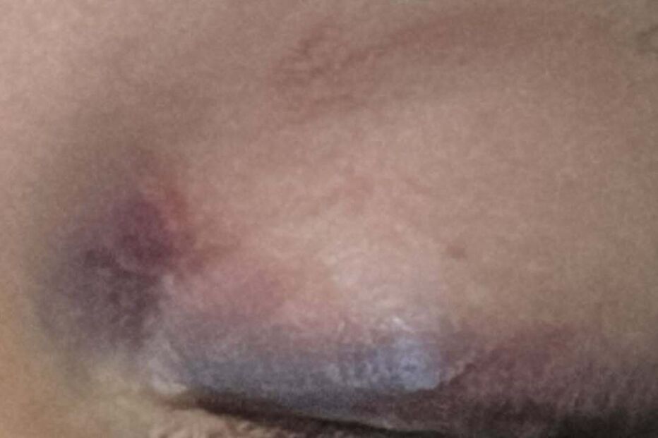 Jéssica Silva com lesão no olho