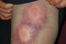 Adepto do Sporting mostra ferimentos na sequência de carga policial da festa do título