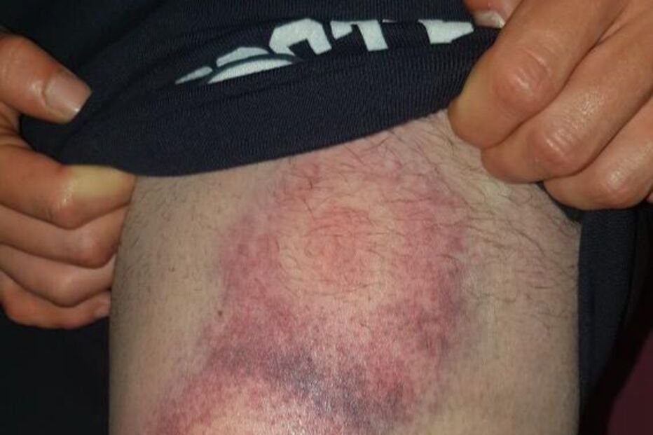 Adepto do Sporting mostra ferimentos na sequência de carga policial da festa do título