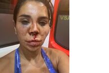 Mulher com ferimentos faciais visíveis, incluindo hematomas e cortes