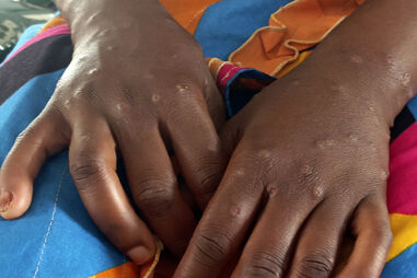 Mais dez portugueses com varíola dos macacos