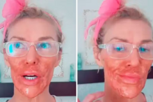 Brandi Glanville sofre queimaduras após usar creme depilatório no rosto