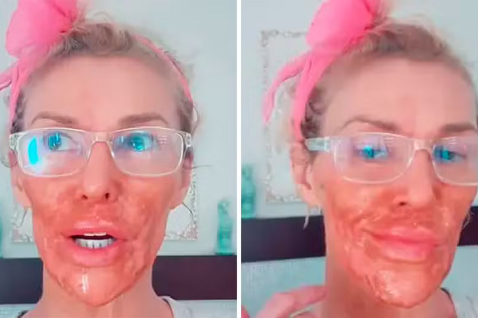 Brandi Glanville sofre queimaduras após usar creme depilatório no rosto