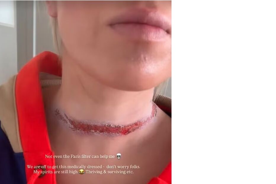 Influenciadora Eli Moulton alerta para perigo de lenços no pescoço após acidente.
