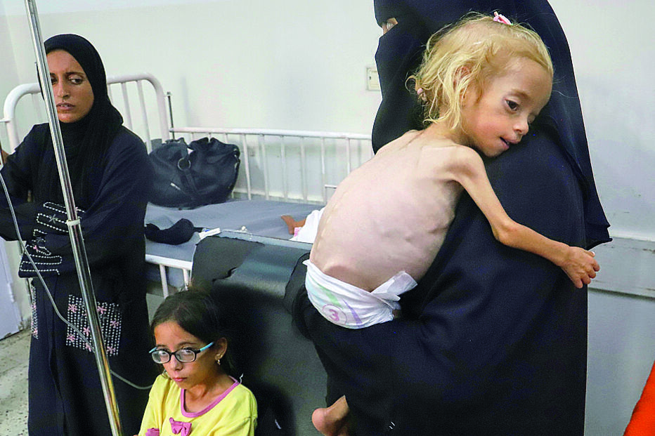 Criança de 2 anos ao colo da mãe. A mal-nutrição em criança deixa sequelas para a vida.