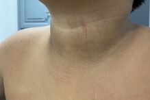 Agrupamento de Escolas de Souselo em Cinfães investiga amputação de dedos de aluno