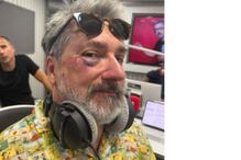 Ricardo Araújo Pereira surge com hematoma no olho