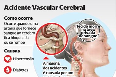AVC: como ocorre, quais as causas, o tratamento e os sintomas a ter atenção