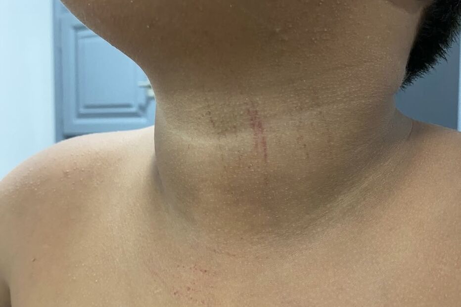 Agrupamento de Escolas de Souselo em Cinfães investiga amputação de dedos de aluno