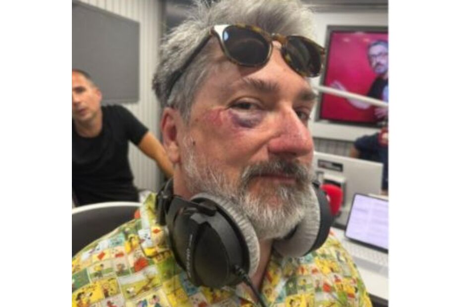 Ricardo Araújo Pereira surge com hematoma no olho