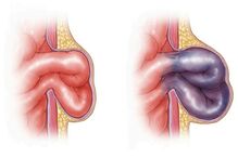 O que é uma hérnia encarcerada: o problema que levou Marcelo Rebelo de Sousa ao hospital