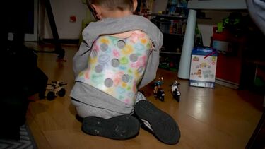 Lourenço nasceu com o coração do lado errado, tem falta de costelas e anomalia no pulmão