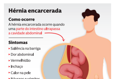 Hérnia encarcerada: sintomas, diagnóstico e cirurgia