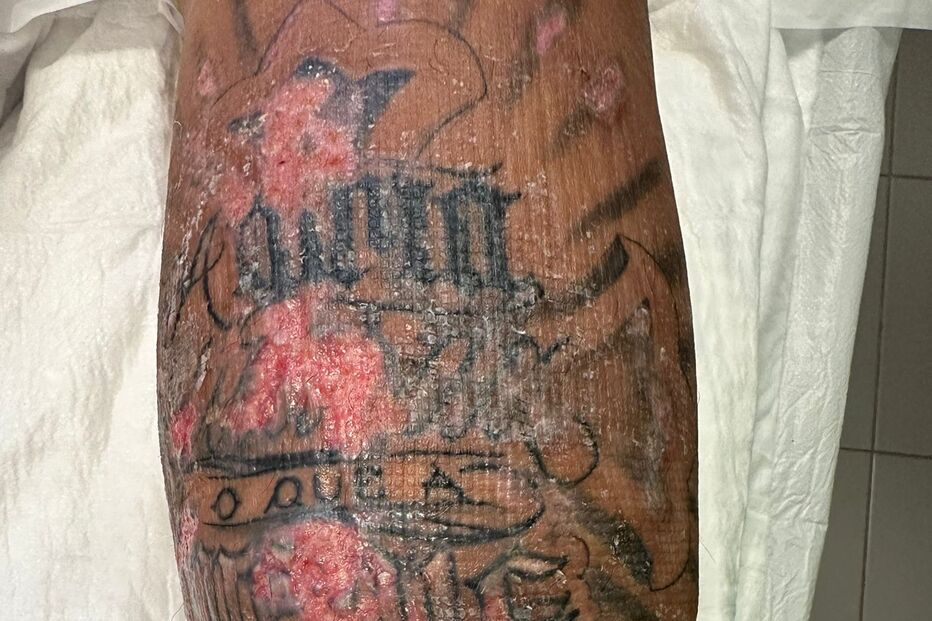 Ex-concorrente do 'Love On Top' expõe complicação após tatuagem 