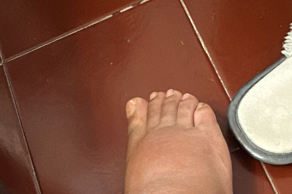 Ex-concorrente do 'Love On Top' expõe complicação após tatuagem 