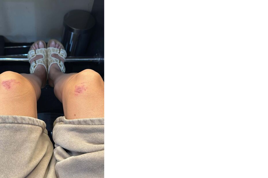 Heidi Klum mostra pernas lesionadas devido a vestido