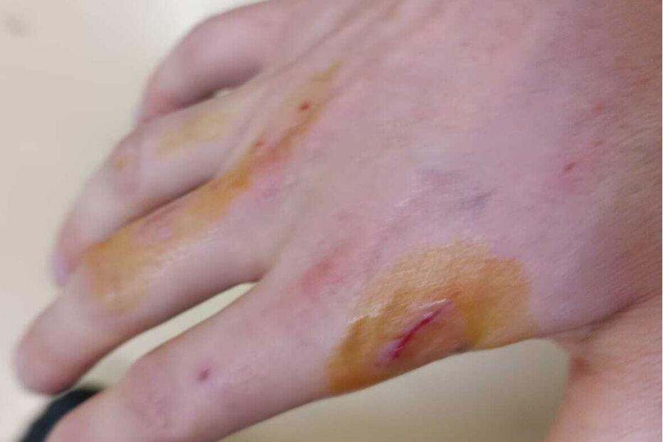 Mão com ferimentos visíveis, incluindo corte e sinais de queimadura