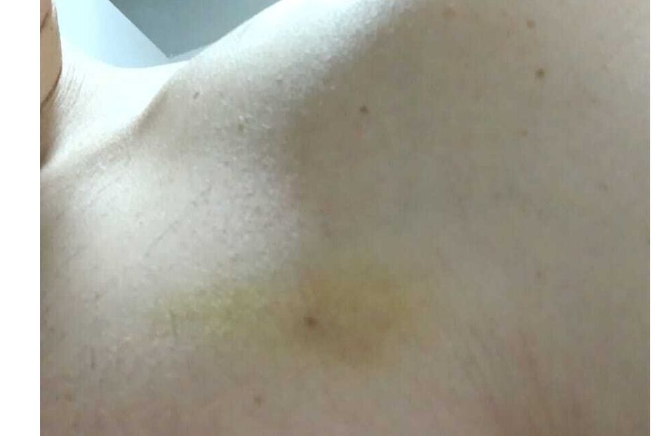 Hematoma visível no ombro de pessoa
