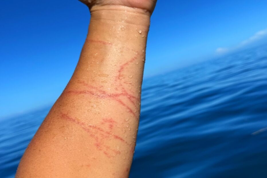 Surfista picada por medusa no Fiji
