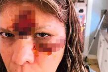 Maria Avila, empregada doméstica de Chris Brown atacada por cão do cantor