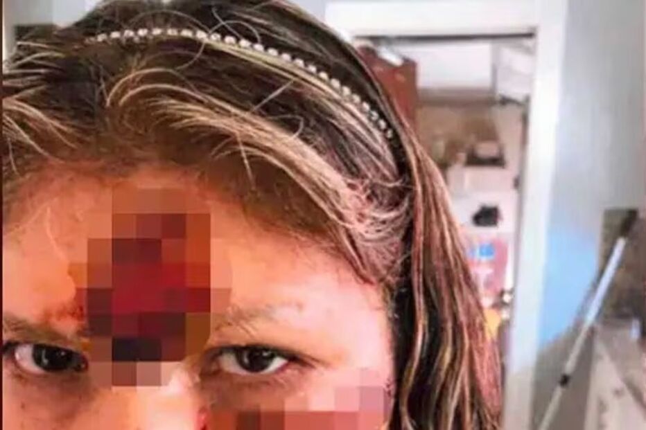 Maria Avila, empregada doméstica de Chris Brown atacada por cão do cantor