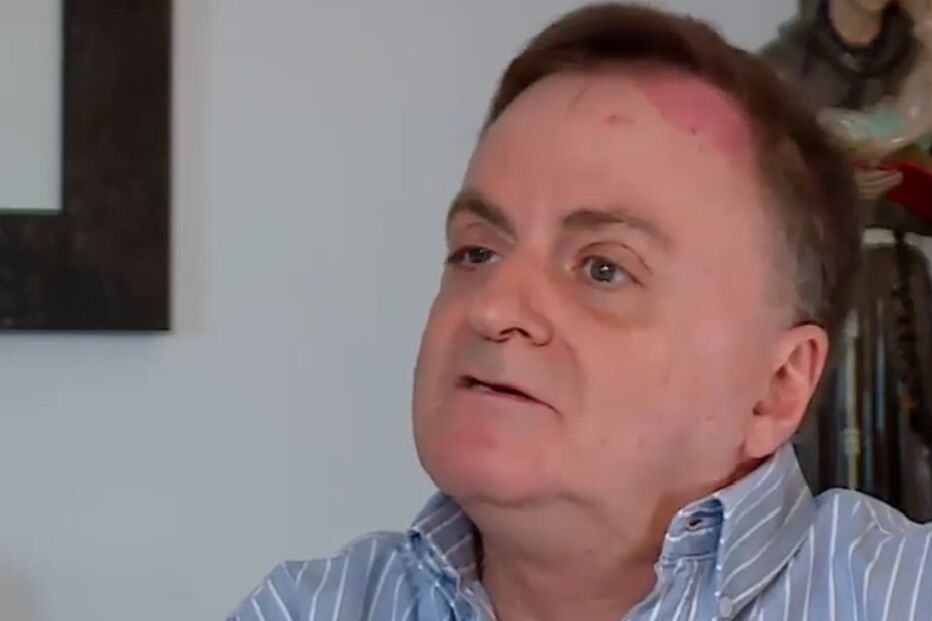 Álvaro vive há seis décadas com várias limitações pela doença epidermólise bolhosa